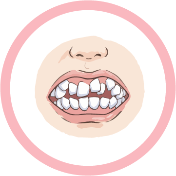 受け口・下の歯が上の歯より前に出ている